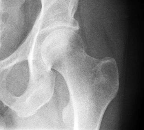 radiografia artrosis grado leve o moderado