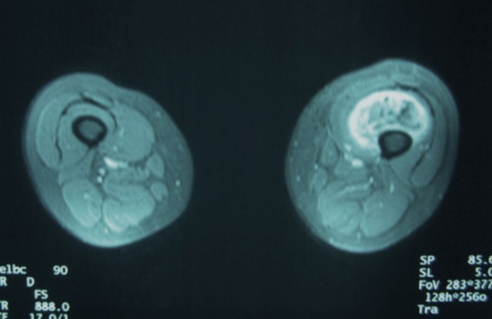 droscartendero-sarcoma-partes-blandas-sinovial-muslo-radiografia.jpg