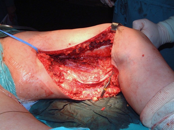 droscartendero-sarcoma-partes-blandas-arteria-femoral-cirugia.jpg