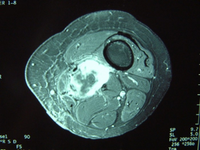 droscartendero-sarcoma-partes-blandas-arteria-femoral-radiografia.jpg