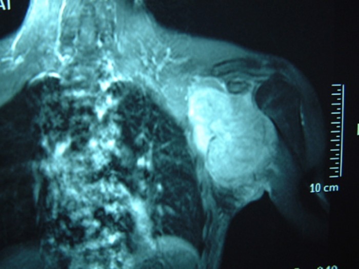 droscartendero-sarcoma-partes-blandas-axila-radiografia.jpg