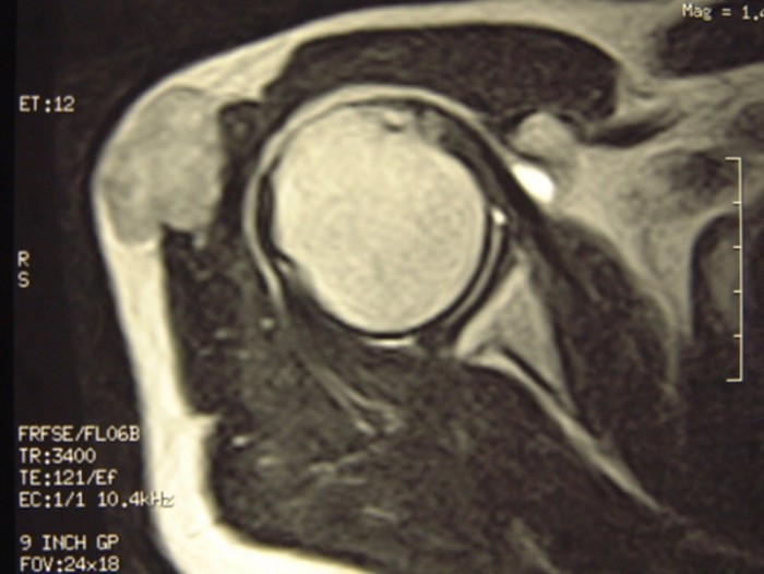 droscartendero-sarcoma-partes-blandas-cirugia-reconstructiva-radiografia.jpg