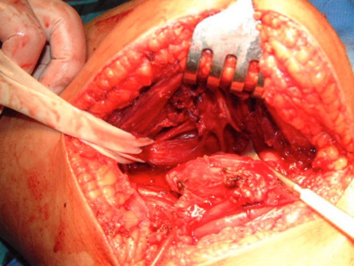 droscartendero-sarcoma-partes-blandas-envolviendo-estructura-nerviosa-muscular-cirugia.jpg